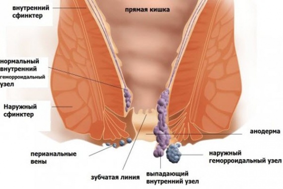Образование и причины геморроя
