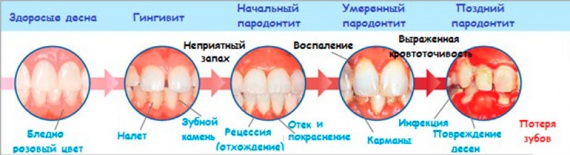 Классификация воспалений десен Классификация воспалений десен