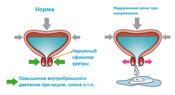 Недержание мочи (схема)