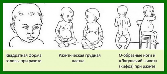 Рахит у ребенка