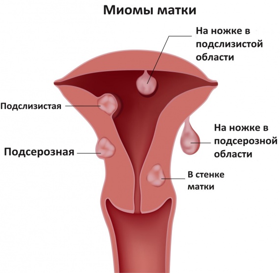 Миома матки